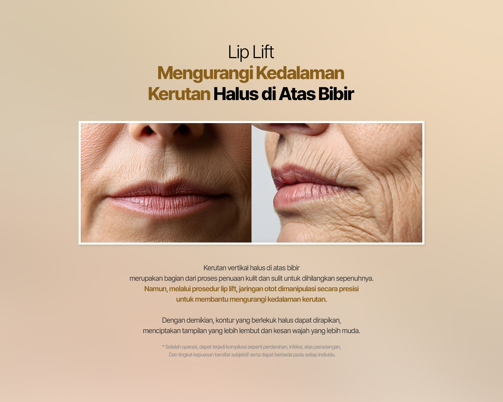 Lip Lift Mengurangi Kedalaman Kerutan Halus di Atas Bibir Kerutan vertikal halus di atas bibir merupakan bagian dari proses penuaan kulit dan sulit untuk dihilangkan sepenuhnya. Namun, melalui prosedur lip lift, jaringan otot dimanipulasi secara presisi untuk membantu mengurangi kedalaman kerutan. Dengan demikian, kontur yang berlekuk halus dapat dirapikan, menciptakan tampilan yang lebih lembut dan kesan wajah yang lebih muda. * Setelah operasi, dapat terjadi kompikasi seperti perdarahan, infeksi, atau peradangan, Dan tingkat kepuasan bersifat subjektif serta dapat berbeda pada setiap individu.
