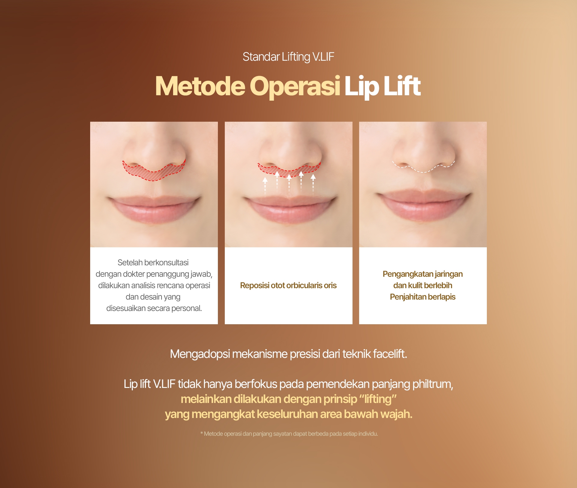 Standar Lifting V.LIF Metode Operasi Lip Lift Setelah berkonsultasi dengan dokter penanggung jawab, dilakukan analisis rencana operasi dan desain yang disesuaikan secara personal. Reposisi otot orbicularis oris Pengangkatan jaringan dan kulit berlebih Penjahitan berlapis Mengadopsi mekanisme presisi dari teknik facelift. Lip lift V.LIF tidak hanya berfokus pada pemendekan panjang philtrum, melainkan dilakukan dengan prinsip “lifting” yang mengangkat keseluruhan area bawah wajah. * Metode operasi dan panjang sayatan dapat berbeda pada setiap individu.