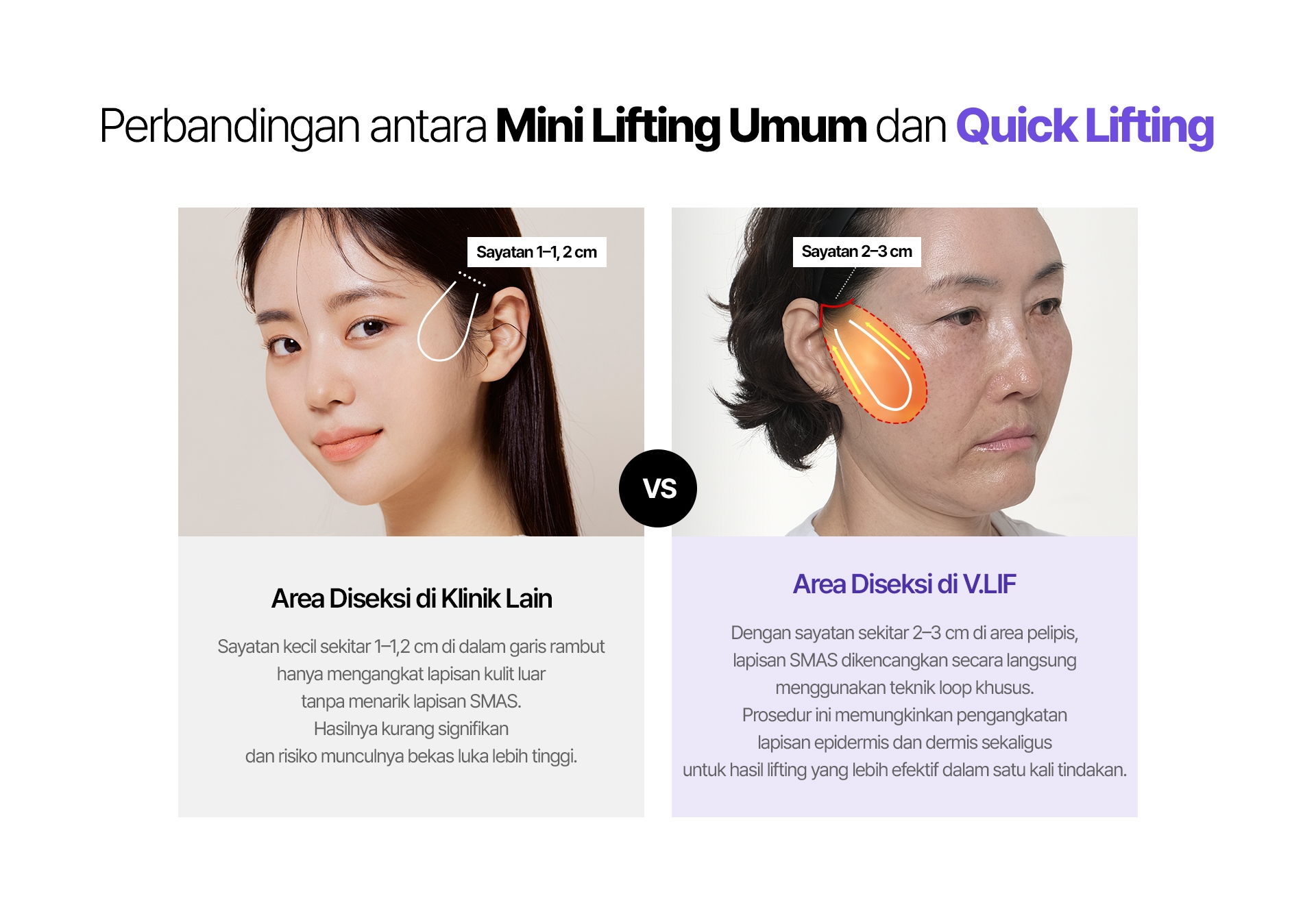 Perbandingan antara Mini Lifting Umum dan Quick Lifting Sayatan 1–1, 2 cm Area Diseksi di Klinik Lain Sayatan kecil sekitar 1–1,2 cm di dalam garis rambut hanya mengangkat lapisan kulit luar tanpa menarik lapisan SMAS. Hasilnya kurang signifikan dan risiko munculnya bekas luka lebih tinggi. Sayatan 2–3 cm Area Diseksi di V.LIF Dengan sayatan sekitar 2–3 cm di area pelipis, lapisan SMAS dikencangkan secara langsung menggunakan teknik loop khusus. Prosedur ini memungkinkan pengangkatan lapisan epidermis dan dermis sekaligus untuk hasil lifting yang lebih efektif dalam satu kali tindakan.