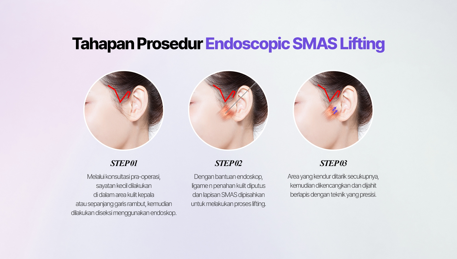 Tahapan Prosedur Endoscopic SMAS Lifting STEP 01 Melalui konsultasi pra-operasi, sayatan kecil dilakukan di dalam area kulit kepala atau sepanjang garis rambut, kemudian dilakukan diseksi menggunakan endoskop. STEP 02 Dengan bantuan endoskop, ligame n penahan kulit diputus dan lapisan SMAS dipisahkan untuk melakukan proses lifting. STEP 03 Area yang kendur ditarik secukupnya, kemudian dikencangkan dan dijahit berlapis dengan teknik yang presisi.