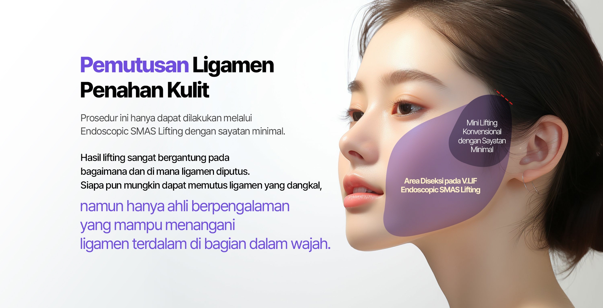 Pemutusan Ligamen Penahan Kulit Prosedur ini hanya dapat dilakukan melalui Endoscopic SMAS Lifting dengan sayatan minimal. Hasil lifting sangat bergantung pada bagaimana dan di mana ligamen diputus. Siapa pun mungkin dapat memutus ligamen yang dangkal, namun hanya ahli berpengalaman yang mampu menangani ligamen terdalam di bagian dalam wajah. Mini Lifting Konvensional dengan Sayatan Minimal Area Diseksi pada V.LIF Endoscopic SMAS Lifting
