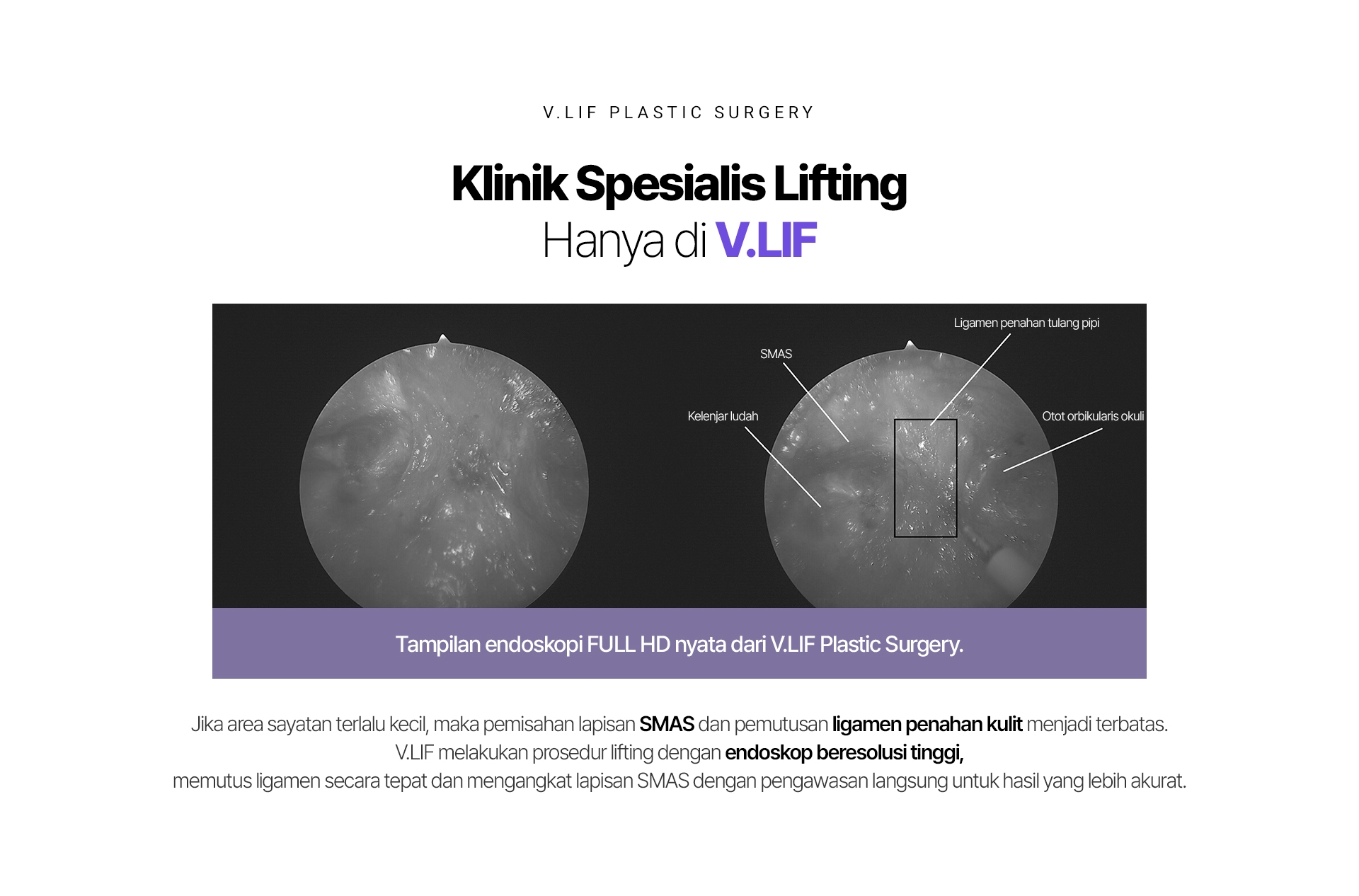 V.LIF PLASTIC SURGERY Klinik Spesialis Lifting Hanya di V.LIF SMAS Kelenjar ludah Ligamen penahan tulang pipi Otot orbikularis okuli Tampilan endoskopi FULL HD nyata dari V.LIF Plastic Surgery. Jika area sayatan terlalu kecil, maka pemisahan lapisan SMAS dan pemutusan ligamen penahan kulit menjadi terbatas. V.LIF melakukan prosedur lifting dengan endoskop beresolusi tinggi, memutus ligamen secara tepat dan mengangkat lapisan SMAS dengan pengawasan langsung untuk hasil yang lebih akurat.