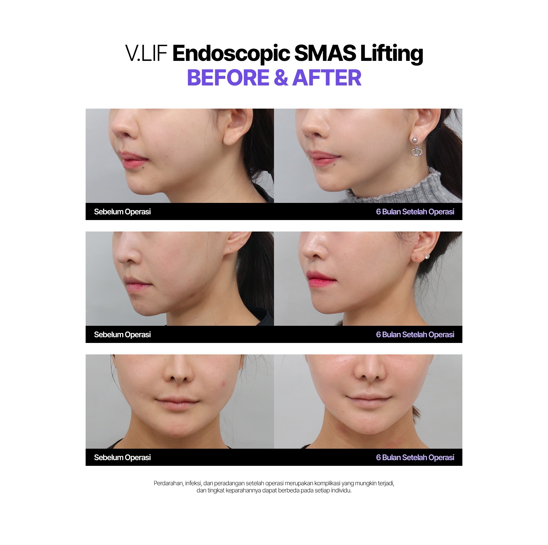 V.LIF Endoscopic SMAS Lifting Before & After Sebelum Operasi 6 Bulan Setelah Operasi Perdarahan, infeksi, dan peradangan setelah operasi merupakan komplikasi yang mungkin terjadi, dan tingkat keparahannya dapat berbeda pada setiap individu.