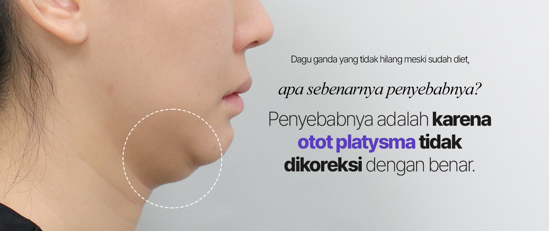 Dagu ganda yang tidak hilang meski sudah diet, apa sebenarnya penyebabnya? Penyebabnya adalah karena otot platysma tidak dikoreksi dengan benar.
