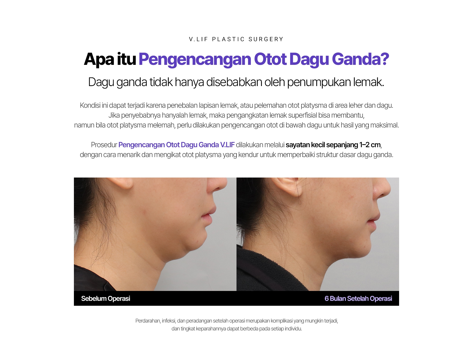 V.LIF PLASTIC SURGERY Apa itu Pengencangan Otot Dagu Ganda? Dagu ganda tidak hanya disebabkan oleh penumpukan lemak. Kondisi ini dapat terjadi karena penebalan lapisan lemak, atau pelemahan otot platysma di area leher dan dagu. Jika penyebabnya hanyalah lemak, maka pengangkatan lemak superfisial bisa membantu, namun bila otot platysma melemah, perlu dilakukan pengencangan otot di bawah dagu untuk hasil yang maksimal. Prosedur Pengencangan Otot Dagu Ganda V.LIF dilakukan melalui sayatan kecil sepanjang 1–2 cm, dengan cara menarik dan mengikat otot platysma yang kendur untuk memperbaiki struktur dasar dagu ganda. Sebelum Operasi 6 Bulan Setelah Operasi Perdarahan, infeksi, dan peradangan setelah operasi merupakan komplikasi yang mungkin terjadi, dan tingkat keparahannya dapat berbeda pada setiap individu.