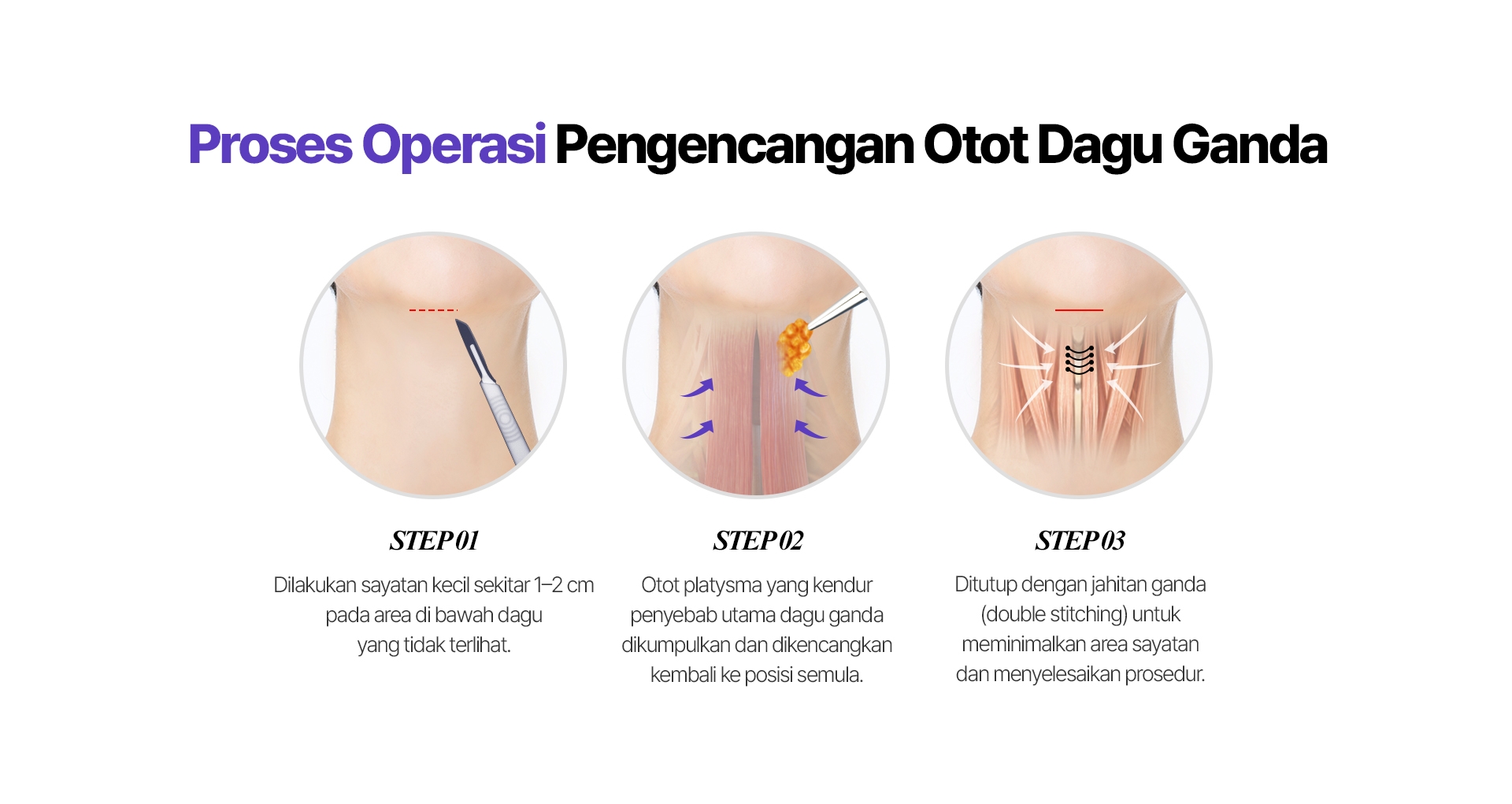 Proses Operasi Pengencangan Otot Dagu Ganda STEP 01 Dilakukan sayatan kecil sekitar 1–2 cm pada area di bawah dagu yang tidak terlihat. STEP 02 Otot platysma yang kendur penyebab utama dagu ganda dikumpulkan dan dikencangkan kembali ke posisi semula. STEP 03 Ditutup dengan jahitan ganda (double stitching) untuk meminimalkan area sayatan dan menyelesaikan prosedur.