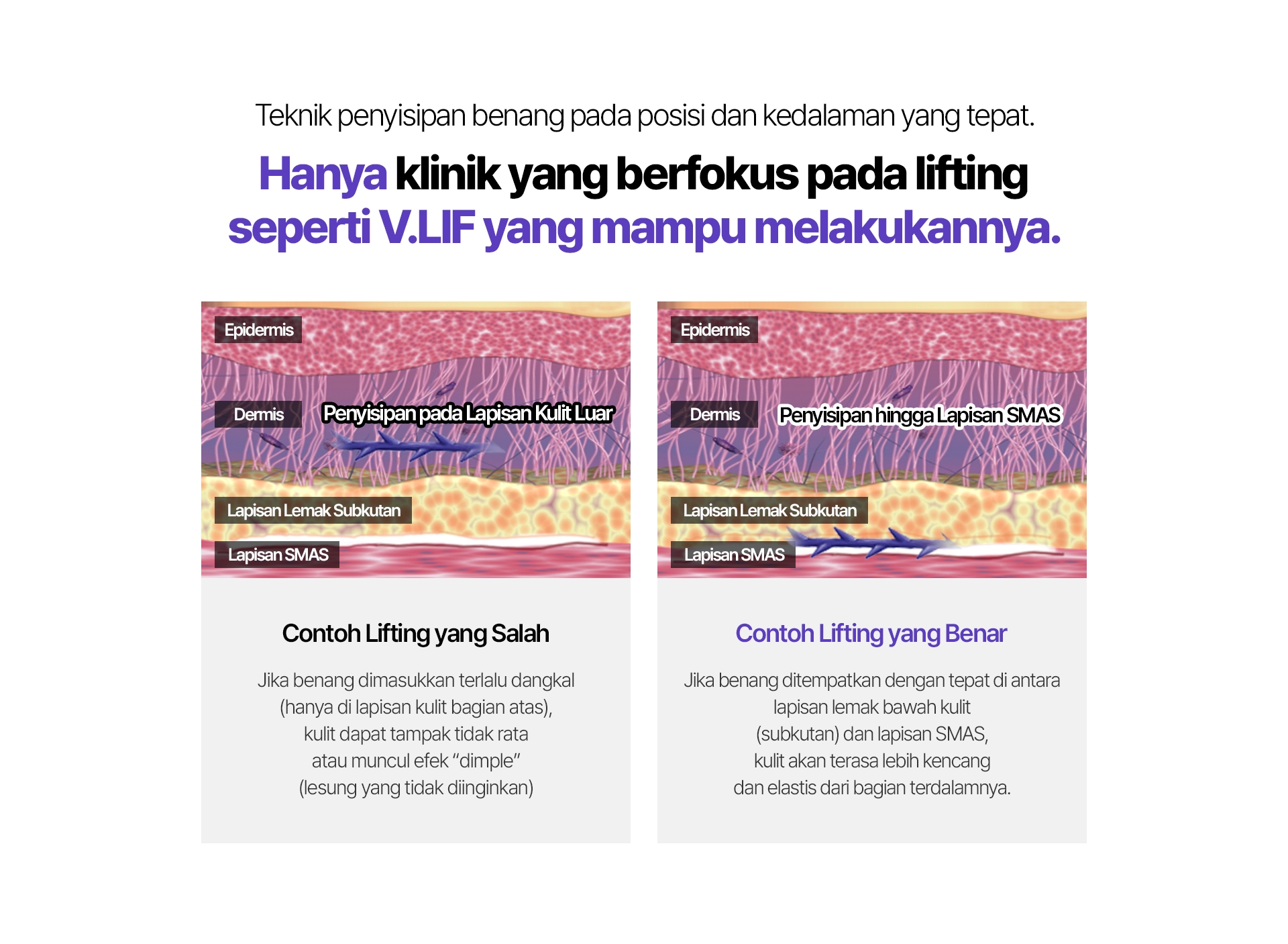 Teknik penyisipan benang pada posisi dan kedalaman yang tepat. Hanya klinik yang berfokus pada lifting seperti V.LIF yang mampu melakukannya. Epidermis Dermis(Penyisipan pada Lapisan Kulit Luar) Lapisan Lemak Subkutan Lapisan SMAS Contoh Lifting yang Salah Jika benang dimasukkan terlalu dangkal (hanya di lapisan kulit bagian atas), kulit dapat tampak tidak rata atau muncul efek “dimple” (lesung yang tidak diinginkan) Epidermis Dermis(Penyisipan hingga Lapisan SMAS ) Lapisan Lemak Subkutan Lapisan SMAS Contoh Lifting yang Benar Jika benang ditempatkan dengan tepat di antara lapisan lemak bawah kulit (subkutan) dan lapisan SMAS, kulit akan terasa lebih kencang dan elastis dari bagian terdalamnya.