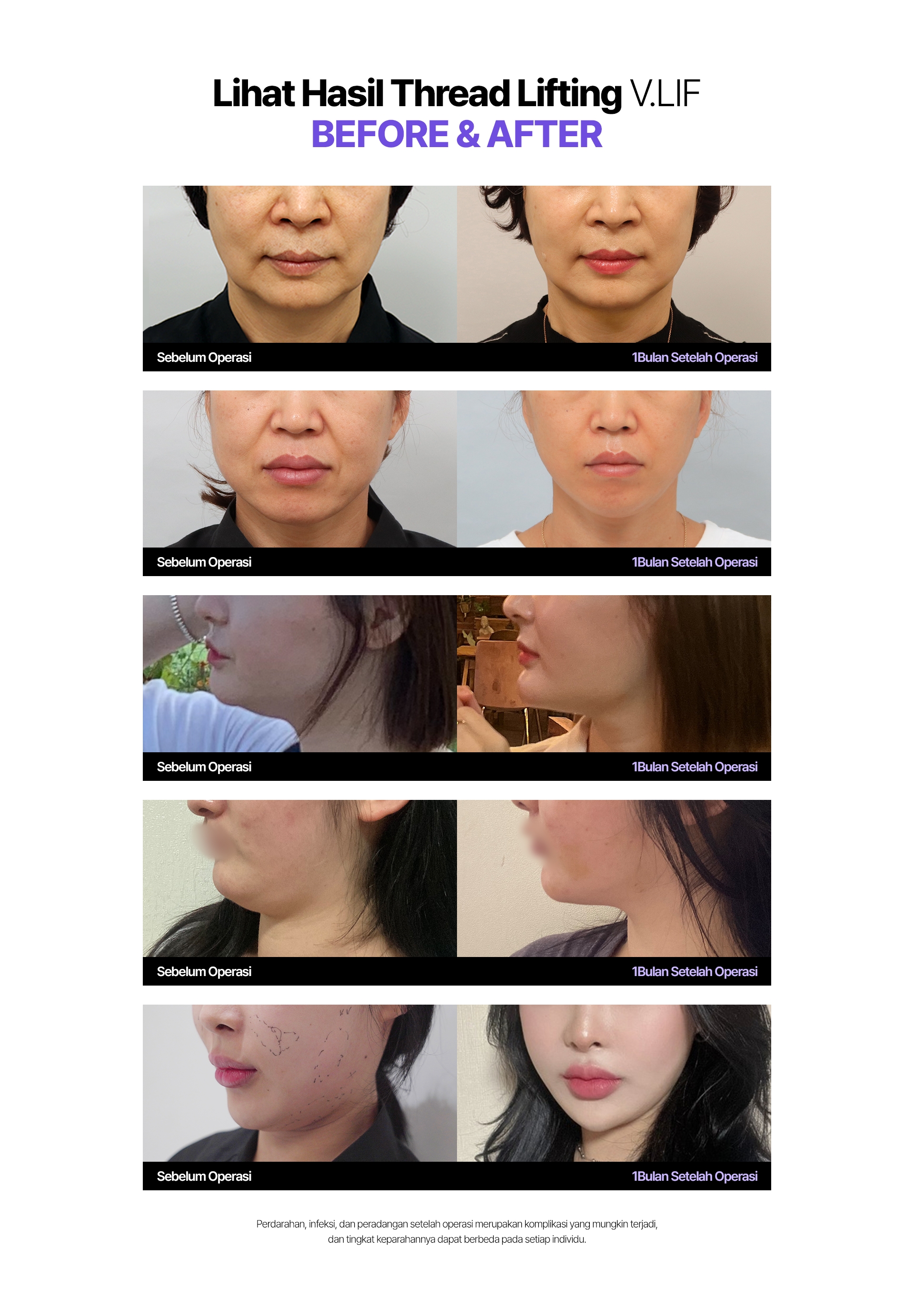 Lihat Hasil Thread Lifting V.LIF Before & After Sebelum Operasi 1Bulan Setelah Operasi Perdarahan, infeksi, dan peradangan setelah operasi merupakan komplikasi yang mungkin terjadi, dan tingkat keparahannya dapat berbeda pada setiap individu.